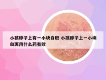小孩脖子上有一小块白斑 小孩脖子上一小块白斑用什么药有效