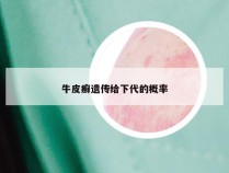 牛皮癣遗传给下代的概率