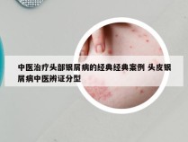中医治疗头部银屑病的经典经典案例 头皮银屑病中医辨证分型