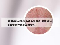银屑病308激光治疗会复发吗 银屑病308激光治疗会复发吗女性