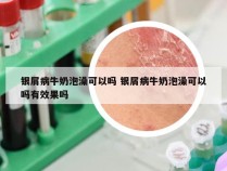 银屑病牛奶泡澡可以吗 银屑病牛奶泡澡可以吗有效果吗