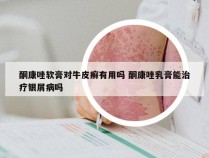 酮康唑软膏对牛皮癣有用吗 酮康唑乳膏能治疗银屑病吗