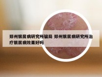 郑州银屑病研究所骗局 郑州银屑病研究所治疗银屑病效果好吗