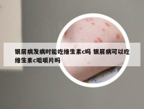 银屑病发病时能吃维生素c吗 银屑病可以吃维生素c咀嚼片吗