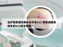 治疗银屑病吃哪些维生素b12 银屑病服用维生素b12用法用量