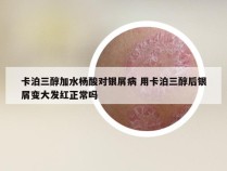 卡泊三醇加水杨酸对银屑病 用卡泊三醇后银屑变大发红正常吗