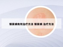 银屑病有效治疗方法 银屑病 治疗方法