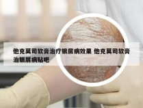 他克莫司软膏治疗银屑病效果 他克莫司软膏治银屑病贴吧