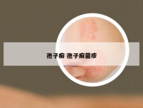 孢子癣 孢子癣菌疹