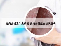 鼻炎会诱发牛皮癣吧 鼻炎会引起皮肤问题吗