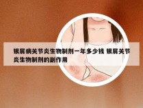 银屑病关节炎生物制剂一年多少钱 银屑关节炎生物制剂的副作用