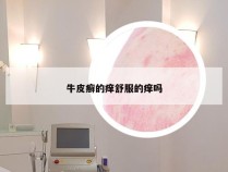 牛皮癣的痒舒服的痒吗