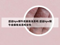 感染hpv跟牛皮癣有关系吗 感染hpv跟牛皮癣有关系吗女性