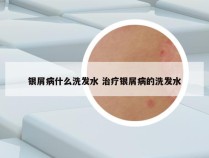 银屑病什么洗发水 治疗银屑病的洗发水