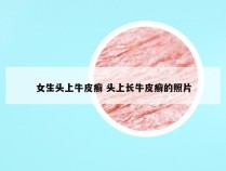 女生头上牛皮癣 头上长牛皮癣的照片