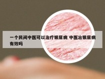 一个民间中医可以治疗银屑病 中医冶银屑病有效吗