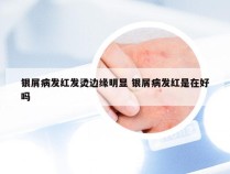 银屑病发红发烫边缘明显 银屑病发红是在好吗