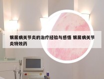 银屑病关节炎的治疗经验与感悟 银屑病关节炎特效药