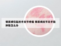 银屑病引起的手关节疼痛 银屑病关节炎手指肿胀怎么办