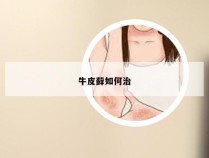 牛皮藓如何治