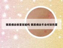 银屑病会损害肾脏吗 银屑病会不会对肾伤害