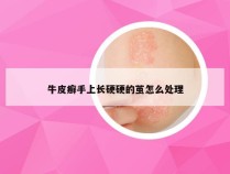 牛皮癣手上长硬硬的茧怎么处理