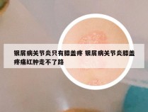 银屑病关节炎只有膝盖疼 银屑病关节炎膝盖疼痛红肿走不了路