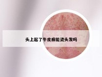 头上起了牛皮癣能烫头发吗