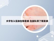大学生入伍体检银屑病 在部队得了银屑病