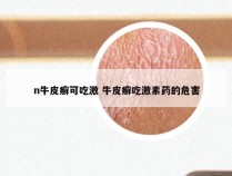n牛皮癣可吃激 牛皮癣吃激素药的危害
