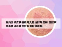 癣药膏和皮肤病血毒丸能治好牛皮癣 皮肤病血毒丸可以联合什么治疗银屑病
