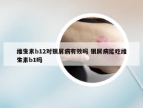 维生素b12对银屑病有效吗 银屑病能吃维生素b1吗