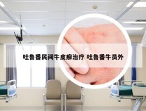 吐鲁番民间牛皮癣治疗 吐鲁番牛员外