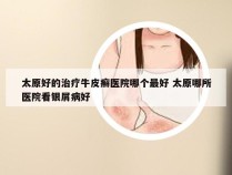 太原好的治疗牛皮癣医院哪个最好 太原哪所医院看银屑病好