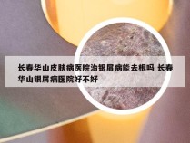 长春华山皮肤病医院治银屑病能去根吗 长春华山银屑病医院好不好