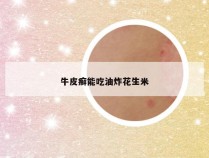 牛皮癣能吃油炸花生米