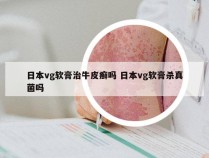 日本vg软膏治牛皮癣吗 日本vg软膏杀真菌吗