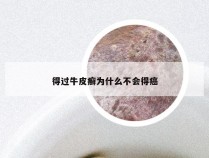得过牛皮癣为什么不会得癌