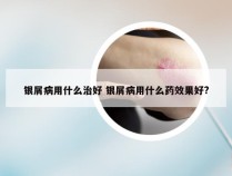 银屑病用什么治好 银屑病用什么药效果好?
