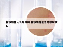 甘草酸苷片治牛皮癣 甘草酸苷能治疗银屑病吗