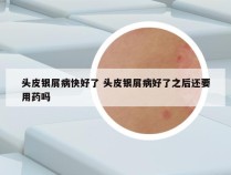头皮银屑病快好了 头皮银屑病好了之后还要用药吗