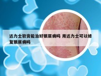 达力士软膏能治好银屑病吗 用达力士可以修复银屑病吗