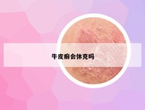 牛皮癣会休克吗