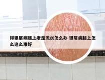 得银屑病腿上老是流水怎么办 银屑病腿上怎么这么难好