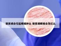 银屑病会引起眼睛肿么 银屑病眼睛会发红么