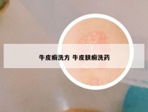 牛皮癣洗方 牛皮肤癣洗药