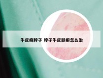 牛皮癣脖子 脖子牛皮肤癣怎么治