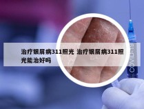 治疗银屑病311照光 治疗银屑病311照光能治好吗