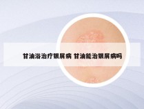 甘油浴治疗银屑病 甘油能治银屑病吗
