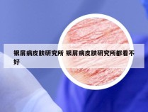银屑病皮肤研究所 银屑病皮肤研究所都看不好